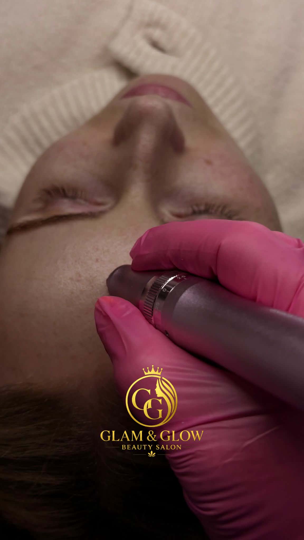 Microneedling