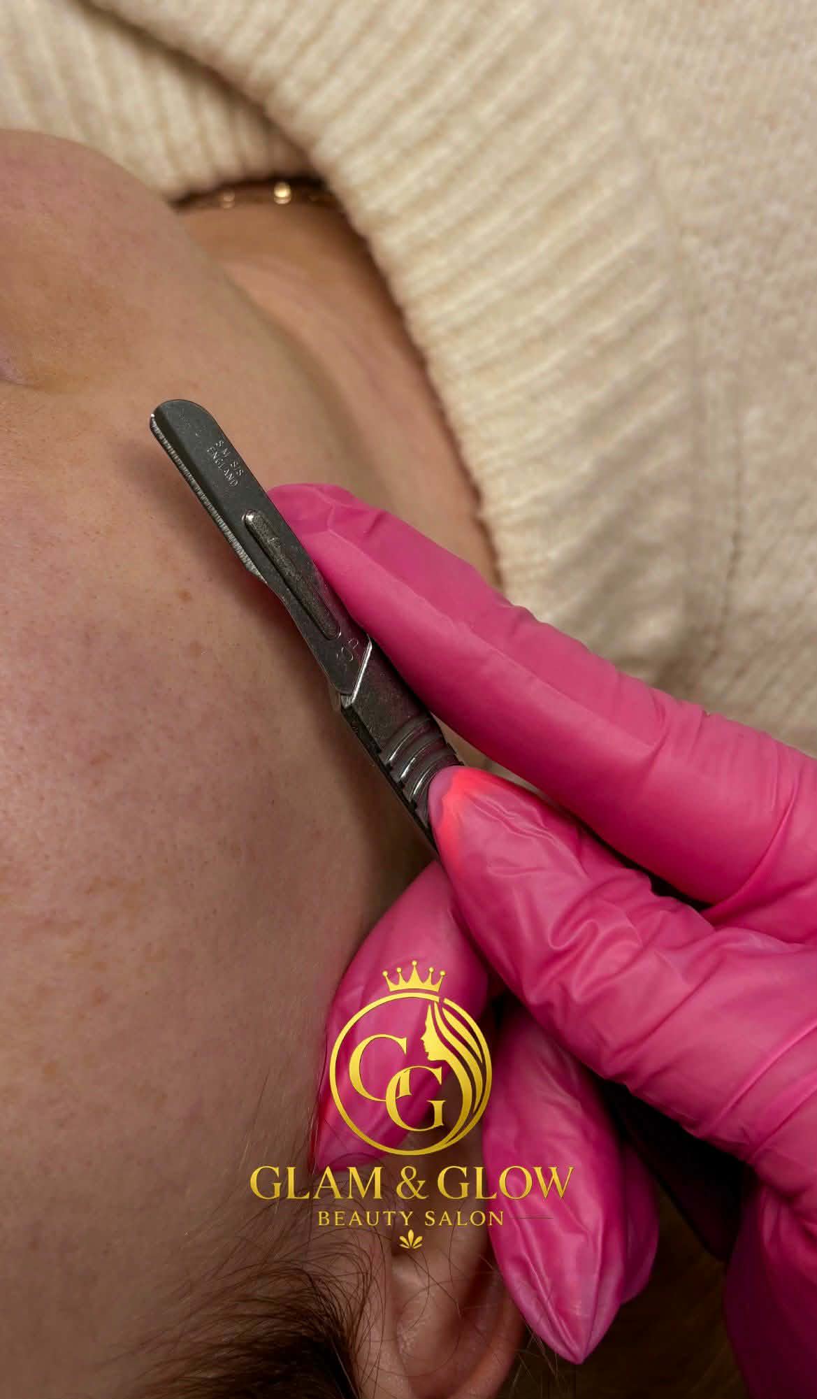 Dermaplaning
